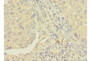 Immunohistochemistry of paraffin-embedded human lung cancer using ABIN7167385 at dilution of 1:100 (RAB8B 抗体  (AA 15-204))