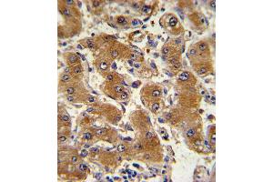 Formalin-fixed and paraffin-embedded human hepatocarcinoma with COL6A1 Antibody , which was peroxidase-conjugated to the secondary antibody, followed by DAB staining. (COL6A1 抗体  (C-Term))