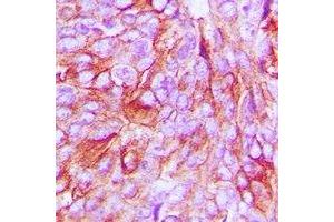 Immunohistochemical analysis of mPR alpha staining in human breast cancer formalin fixed paraffin embedded tissue section. (PAQR7 抗体  (C-Term))