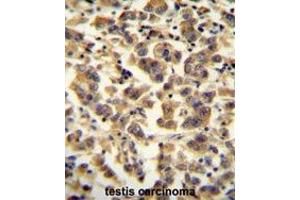 TTC39B antibody (C-term) immunohistochemistry analysis in formalin fixed and paraffin embedded human testis carcinoma followed by peroxidase conjugation of the secondary antibody and DAB staining. (TTC39B 抗体  (C-Term))