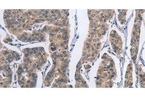 Immunohistochemistry of paraffin-embedded Human breast cancer tissue using DSG2 Polyclonal Antibody at dilution 1:50 (Desmoglein 2 抗体)