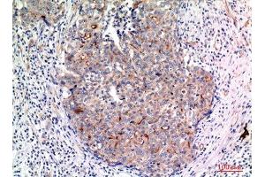 Immunohistochemistry (IHC) image for anti-Mucin 1 (MUC1) (Internal Region) antibody (ABIN6280749)