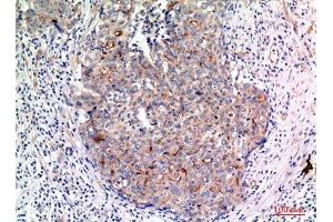 Immunohistochemistry (IHC) analysis of paraffin-embedded Human Breast Cancer, antibody was diluted at 1:100. (MUC1 抗体  (Internal Region))