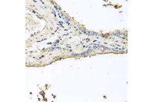 Immunohistochemistry of paraffin-embedded human lung cancer using INS antibody at dilution of 1:100 (40x lens). (Insulin 抗体)