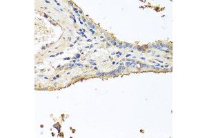 Immunohistochemistry of paraffin-embedded human lung cancer using INS antibody at dilution of 1:100 (40x lens).