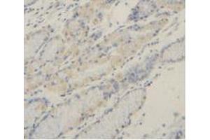 Detection of MMP2 in Human Stomach Cancer Tissue using Polyclonal Antibody to Matrix Metalloproteinase 2 (MMP2) (MMP2 抗体  (AA 445-660))