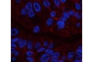 Immunofluorescence analysis of Human liver cancer tissue using CA9 Monoclonal Antibody at dilution of 1:200. (CA9 抗体)