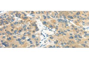 Immunohistochemistry of paraffin-embedded Human liver cancer tissue using CD70 Polyclonal Antibody at dilution 1:40 (CD70 抗体)