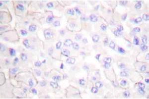 Immunohistochemistryanalysis of E-cadherin (pArg868) Antibody in paraffin-embedded human breast carcinoma tissue. (E-cadherin 抗体)