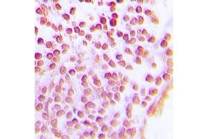 Immunohistochemical analysis of SIRT1 staining in human lung cancer formalin fixed paraffin embedded tissue section. (SIRT1 抗体)