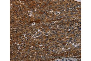Immunohistochemistry of Human thyroid cancer using IVL Polyclonal Antibody at dilution of 1:50 (Involucrin 抗体)