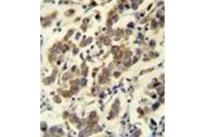 Immunohistochemistry analysis in formalin fixed and paraffin embedded human testis carcinoma reacted with MBD3L3 Antibody (C-term) followed which was peroxidase conjugated to the secondary antibody and followed by DAB staining. (MBD3L3 抗体  (C-Term))