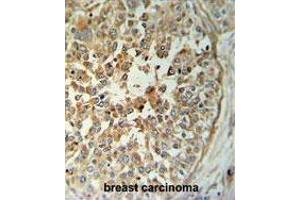 TM173 Antibody (C-term) IHC analysis in formalin fixed and paraffin embedded breast carcinoma followed by peroxidase conjugation of the secondary antibody and DAB staining. (STING/TMEM173 抗体  (C-Term))