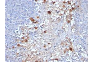 Formalin-fixed, paraffin-embedded human Melanoma stained with MCAM Mouse Monoclonal Antibody (MCAM/1101). (MCAM 抗体)
