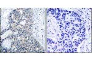 Immunohistochemistry analysis of paraffin-embedded human breast carcinoma, using Stathmin 1 (Phospho-Ser37) Antibody. (Stathmin 1 抗体  (pSer38))