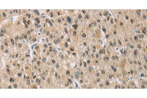 Immunohistochemistry of paraffin-embedded Human liver cancer using NAPSA Polyclonal Antibody at dilution of 1:50 (NAPSA 抗体)