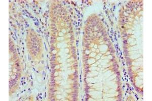 Immunohistochemistry (IHC) image for anti-Tumor Protein P53 (TP53) antibody (ABIN7172317)