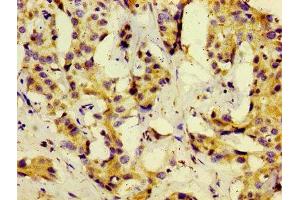 Immunohistochemistry of paraffin-embedded human liver cancer using ABIN7159562 at dilution of 1:100 (KISS1 抗体  (AA 20-138))