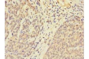 Immunohistochemistry of paraffin-embedded human ovarian cancer using ABIN7174603 at dilution of 1:100