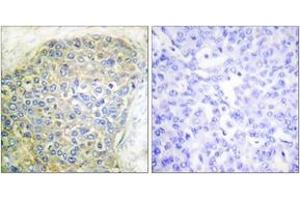Immunohistochemistry analysis of paraffin-embedded human breast carcinoma tissue, using HSL (Ab-554) Antibody. (LIPE 抗体  (AA 520-569))