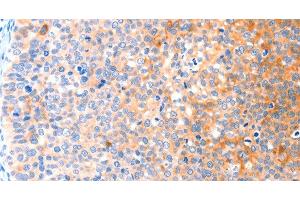 Immunohistochemistry of paraffin-embedded Human cervical cancer tissue using CCDC88A Polyclonal Antibody at dilution 1:50 (Girdin 抗体)