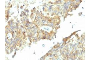 IHC testing of FFPE human ovarian carcinoma with Alkaline Phosphatase antibody (ALPL/597). (Alkaline Phosphatase 抗体)