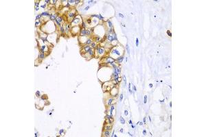 Immunohistochemistry of paraffin-embedded human liver cancer using BCL2 antibody. (Bcl-2 抗体)