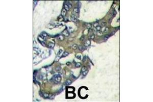 Forlin-fixed and paraffin-embedded hun breast carcino tissue reacted with PK1 Antibody (C-term) (ABIN1882175 and ABIN2841383) , which was peroxidase-conjugated to the secondary antibody, followed by DAB staining. (ERK2 抗体  (C-Term))