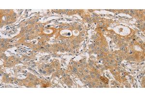 Immunohistochemistry of paraffin-embedded Human gasrtic cancer tissue using ARSK Polyclonal Antibody at dilution 1:30 (Arylsulfatase K 抗体)