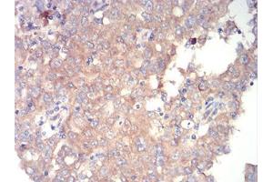 Immunohistochemical analysis of paraffin-embedded endometrial cancer tissues using mTOR mouse mAb with DAB staining. (MTOR 抗体  (AA 2311-2529))
