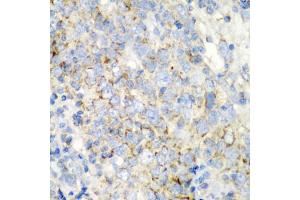Immunohistochemistry of paraffin-embedded human esophageal cancer using PRKCQ antibody (ABIN5975395) at dilution of 1/200 (40x lens). (PKC theta 抗体)