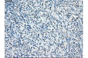 Immunohistochemical staining of paraffin-embedded Carcinoma of thyroid tissue using anti-PORmouse monoclonal antibody. (POR 抗体)