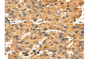 The image on the left is immunohistochemistry of paraffin-embedded Human liver cancer tissue using ABIN7131050(SH3KBP1 Antibody) at dilution 1/45, on the right is treated with fusion protein. (SH3KBP1 抗体)