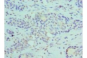Immunohistochemistry of paraffin-embedded human breast cancer using ABIN7168694 at dilution of 1:100 (SLURP1 抗体  (AA 1-103))