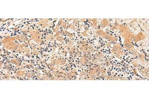 Immunohistochemistry of paraffin-embedded Human liver cancer tissue using HPCA Polyclonal Antibody at dilution of 1:30(x200) (Hippocalcin 抗体)