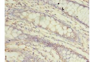 Immunohistochemistry of paraffin-embedded human colon cancer using ABIN7172361 at dilution of 1:100 (TRAPPC3 抗体  (AA 1-180))