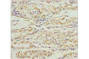 Immunohistochemistry of paraffin-embedded human gastric cancer using ABIN7164013 at dilution of 1:100 (KCNS3 抗体  (AA 1-180))