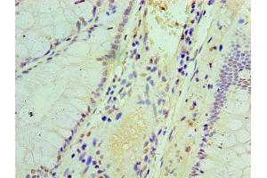 Immunohistochemistry of paraffin-embedded human colon cancer using ABIN7156671 at dilution of 1:100 (IFIT3 抗体  (AA 1-490))