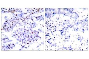 Immunohistochemical analysis of paraffin-embedded human breast carcinoma tissue using STAT6 (Ab-645) antibody (E021051). (STAT6 抗体)