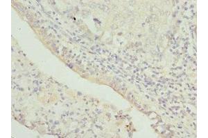 Immunohistochemistry of paraffin-embedded human lung cancer using ABIN7172352 at dilution of 1:100 (TRAPPC1 抗体  (AA 1-260))