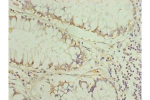 Immunohistochemistry of paraffin-embedded human colon cancer using ABIN7151254 at dilution of 1:100 (TRIM31 抗体  (AA 186-425))
