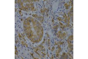 Immunohistochemistry of paraffin-embedded human gastric cancer using BIN1 Antibody (ABIN5970905) at dilution of 1/200 (40x lens). (BIN1 抗体)