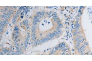 Immunohistochemistry of paraffin-embedded Human colon cancer using PDX1 Polyclonal Antibody at dilution of 1:30 (PDX1 抗体)