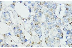 Immunohistochemistry of paraffin-embedded Human mammary cancer using SOD3 Polyclonal Antibody at dilution of 1:100 (40x lens). (SOD3 抗体)