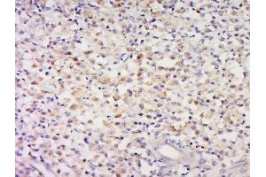Paraformaldehyde-fixed, paraffin embedded human cervical carcinoma tissue, Antigen retrieval by boiling in sodium citrate buffer(pH6) for 15min, Block endogenous peroxidase by 3% hydrogen peroxide for 30 minutes, Blocking buffer (normal goat serum) at 37°C for 20min, Antibody incubation with Rabbit Anti-CCDC58 Polyclonal Antibody, Unconjugated  at 1:500 overnight at 4°C, followed by a conjugated secondary and DAB staining (CCDC58 抗体  (AA 71-144))