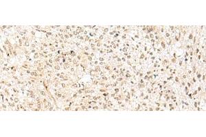 Immunohistochemistry of paraffin-embedded Human liver cancer tissue using RBX1 Polyclonal Antibody at dilution of 1:50(x200) (RBX1 抗体)