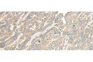 Immunohistochemistry of paraffin-embedded Human liver cancer tissue using RSU1 Polyclonal Antibody at dilution of 1:30(x200) (RSU1 抗体)