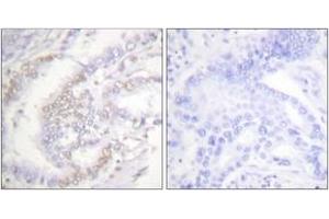 Immunohistochemistry analysis of paraffin-embedded human lung carcinoma, using FANCD2 (Phospho-Ser222) Antibody. (FANCD2 抗体  (pSer222))