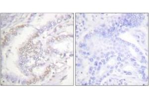 Immunohistochemistry analysis of paraffin-embedded human lung carcinoma, using FANCD2 (Phospho-Ser222) Antibody.