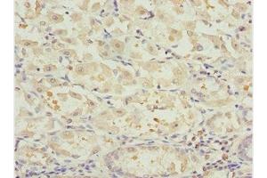 Immunohistochemistry of paraffin-embedded human gastric cancer using ABIN7161725 at dilution of 1:100 (NLE1 抗体  (AA 206-485))